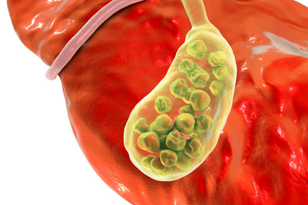 Gallstones, 3D illustration showing bottom view of liver and gallbladder with stones